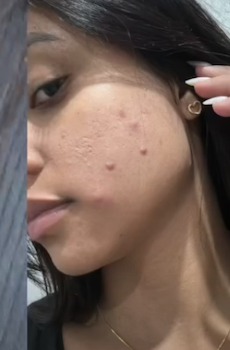Antes do tratamento — close da pele com manchas